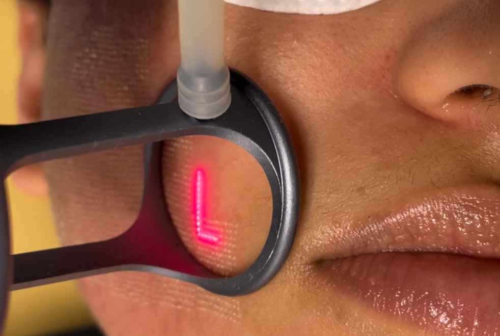 Laser treatment