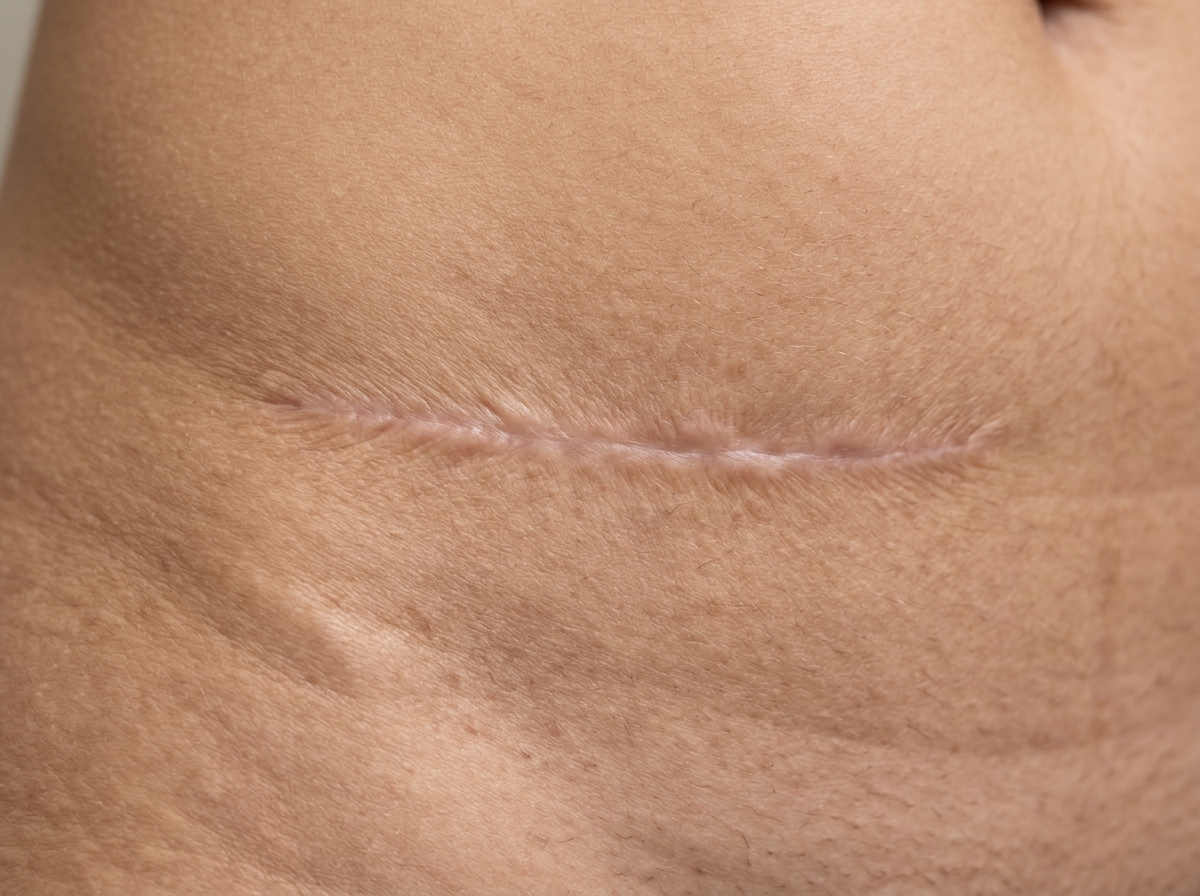 Surgical Scar Revision